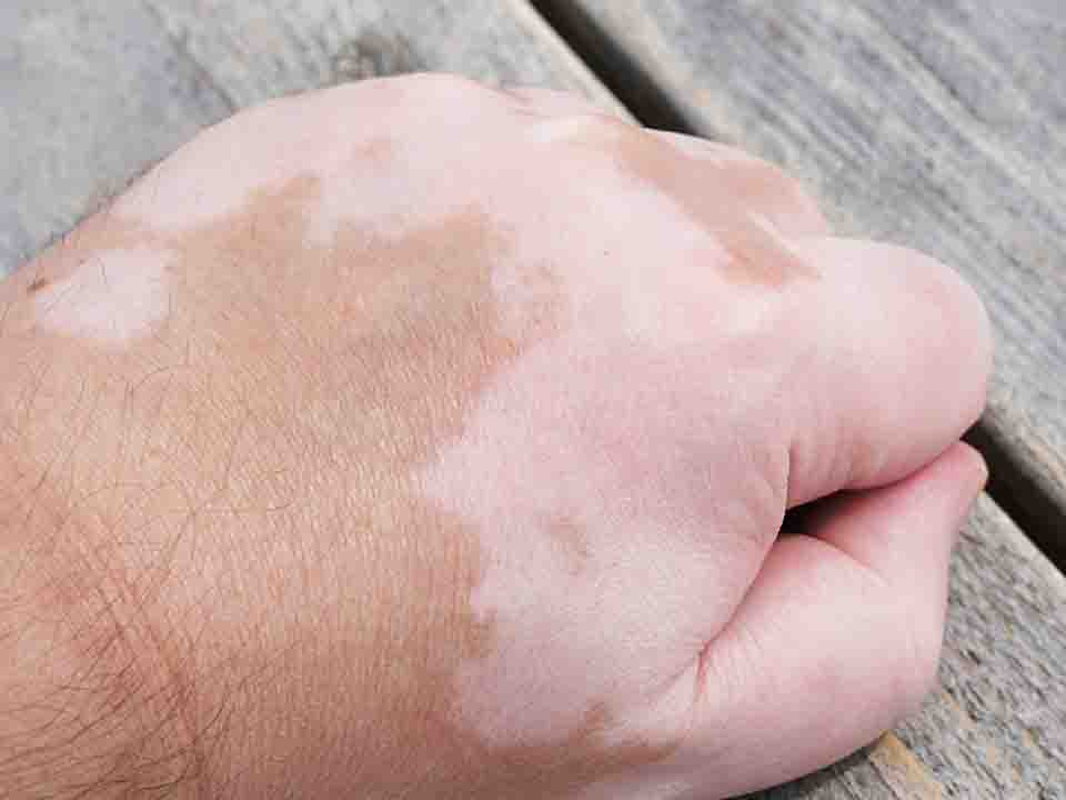 白癜风就是皮肤变白吗?