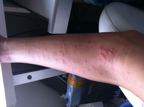 荨麻疹发病时有哪些特征和特点?