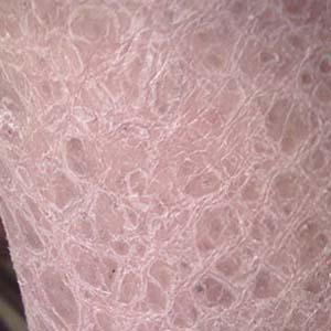 鱼鳞病是不是遗传性的皮肤病呢?