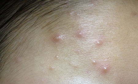 痤疮和火疖子是不是一样的症状?