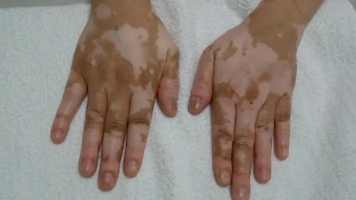 白癜风是不是和微量元素缺失有关吗?