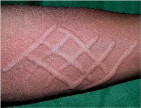 荨麻疹会不会传染给家人呢?