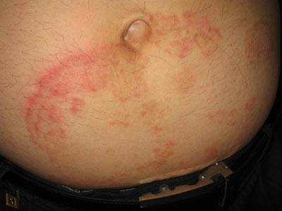 体癣都有哪些具体的症状和表现呢?