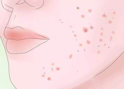 扁平疣是病毒感染还是真菌引起的?