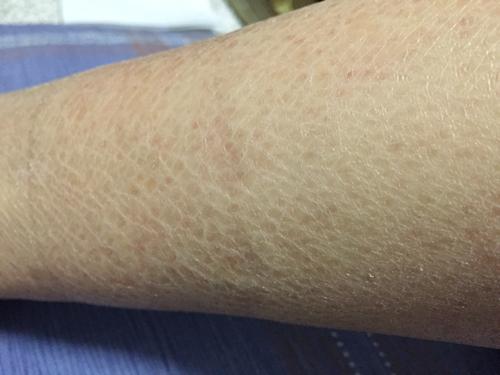 鱼鳞病会对皮肤有什么影响和危害呢?