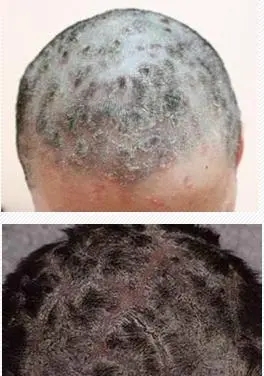 脂溢性皮炎都是哪些原因引起的呢?