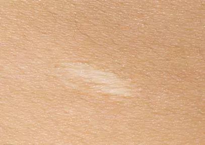 疤痕患者应当注意哪些治疗误区呢?