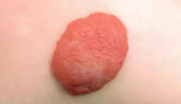 胎记是不是会遗传给孩子呢?