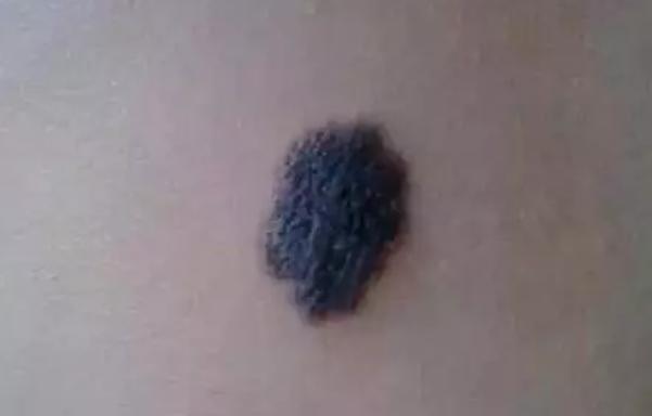 胎记都有哪些颜色和体现呢?