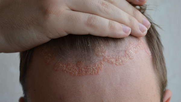 头癣都是什么原因引起的疾病呢?