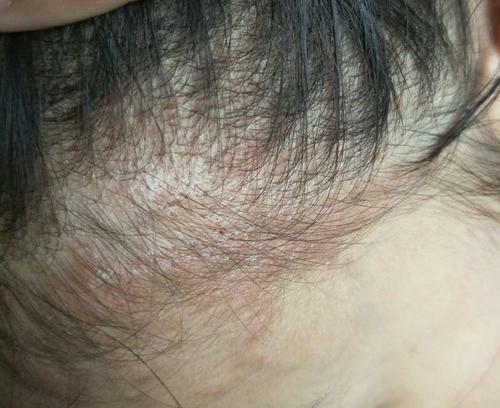 头癣治疗上为什么会反复复发呢?