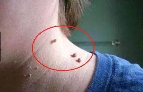 引起丝状疣的直接和间接原因有哪些?