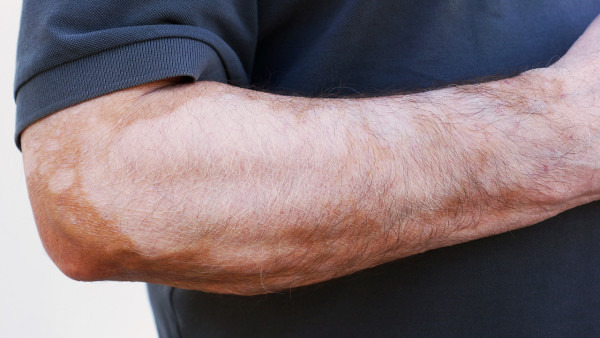 银屑病治疗的目的都有哪些呢?