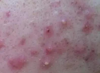 痤疮是不是炎症引起的皮肤疾病?