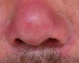 生活中如何判断是不是酒糟鼻表现呢?