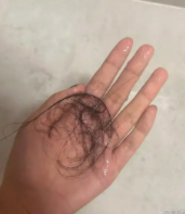 头上脱发严重是肾虚引起的吗?