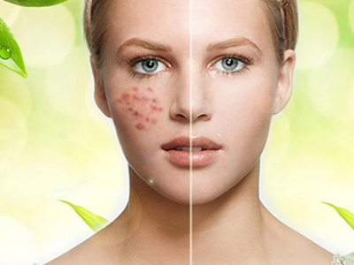 雀斑都是什么原因引起的呢?