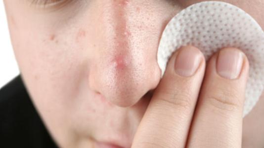 雀斑都有哪些类型，应当如何做好护理?
