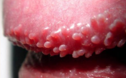 湿疣是什么原因引起的，如何传染的?