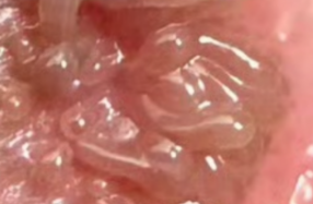 湿疣都有哪些典型症状表现呢?