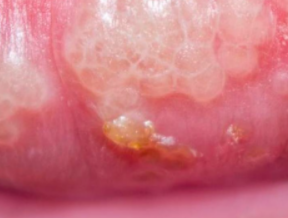 生殖疱疹都是什么原因造成的?