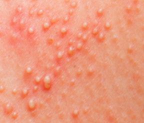 生殖疱疹都有哪些症状和损害呢?