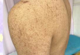 毛周角化是什么原因引起的呢?