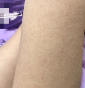 毛周角化是不是鸡皮肤呢?