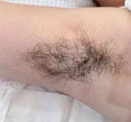 腋毛是不是可以激光去除呢?