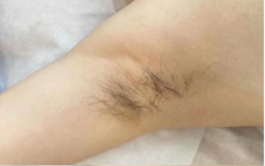 体毛旺盛都是什么样的原因引起的?