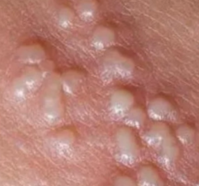 生殖疱疹生活需要注意哪些事项?