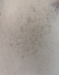 雀斑是身体有什么问题吗，如何护理呢?