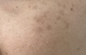 黄褐斑是老年斑吗，要如何护理呢?