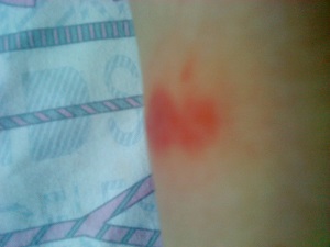 春季皮肤过敏除了瘙痒还有哪些症状?