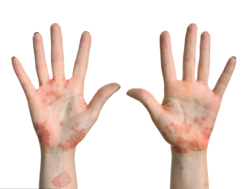 手癣是因为缺乏维生素引起的吗?