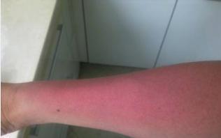 神经性皮炎应当要注意哪些事项?