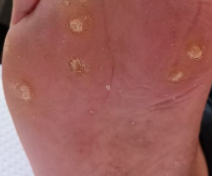 跖疣都有哪些症状和表现呢?