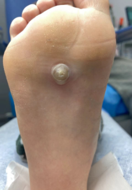 跖疣是不是只会在脚上呢?