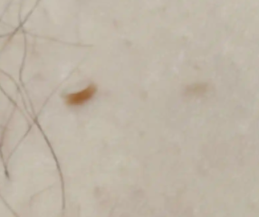 丝状疣好发于什么部位呢?