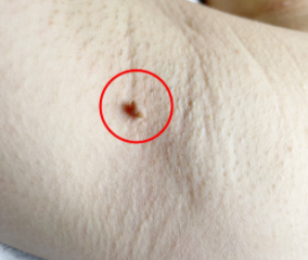 丝状疣是什么病毒引起的疾病?