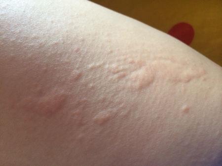 荨麻疹为什么会越抓越痒呢?