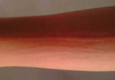 荨麻疹会出现在大腿内侧吗?