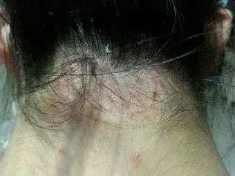 脂溢性皮炎会出现白色脓包吗?