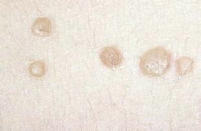 扁平疣和老年斑有什么区别?