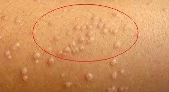 扁平疣能不能自行剪掉呢?