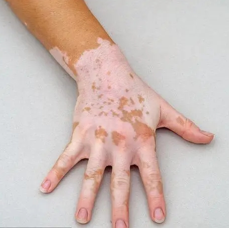 白癜风有没有自愈的可能呢?