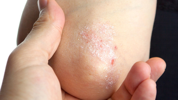 银屑病平时要注意什么事项呢?