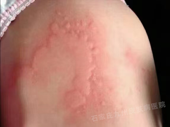 过敏性荨麻疹有什么特征表现?