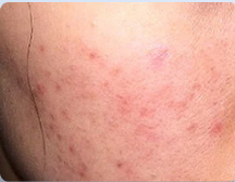 青春痘痘坑形成的原因有哪些?