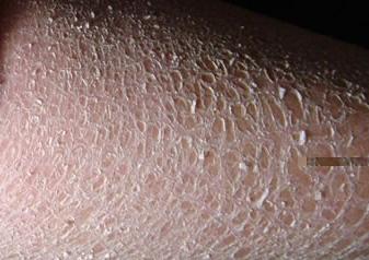 鱼鳞病患者洗澡时要注意什么事项?